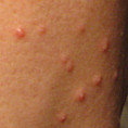 Advanced Molluscum Contagiosum Bumps