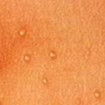 Molluscum Contagiosum Symptoms